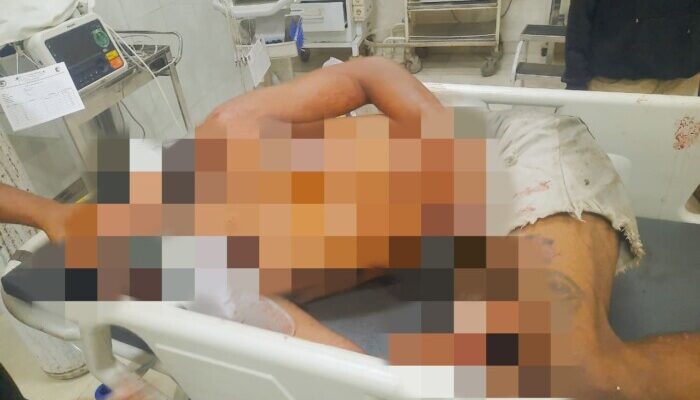Kecelakaan Lalu Lintas di Sikka, Dump Truk Vs Sepeda Motor, Pengendara Alami Patah Tulang Tangan Kiri dan Kanan